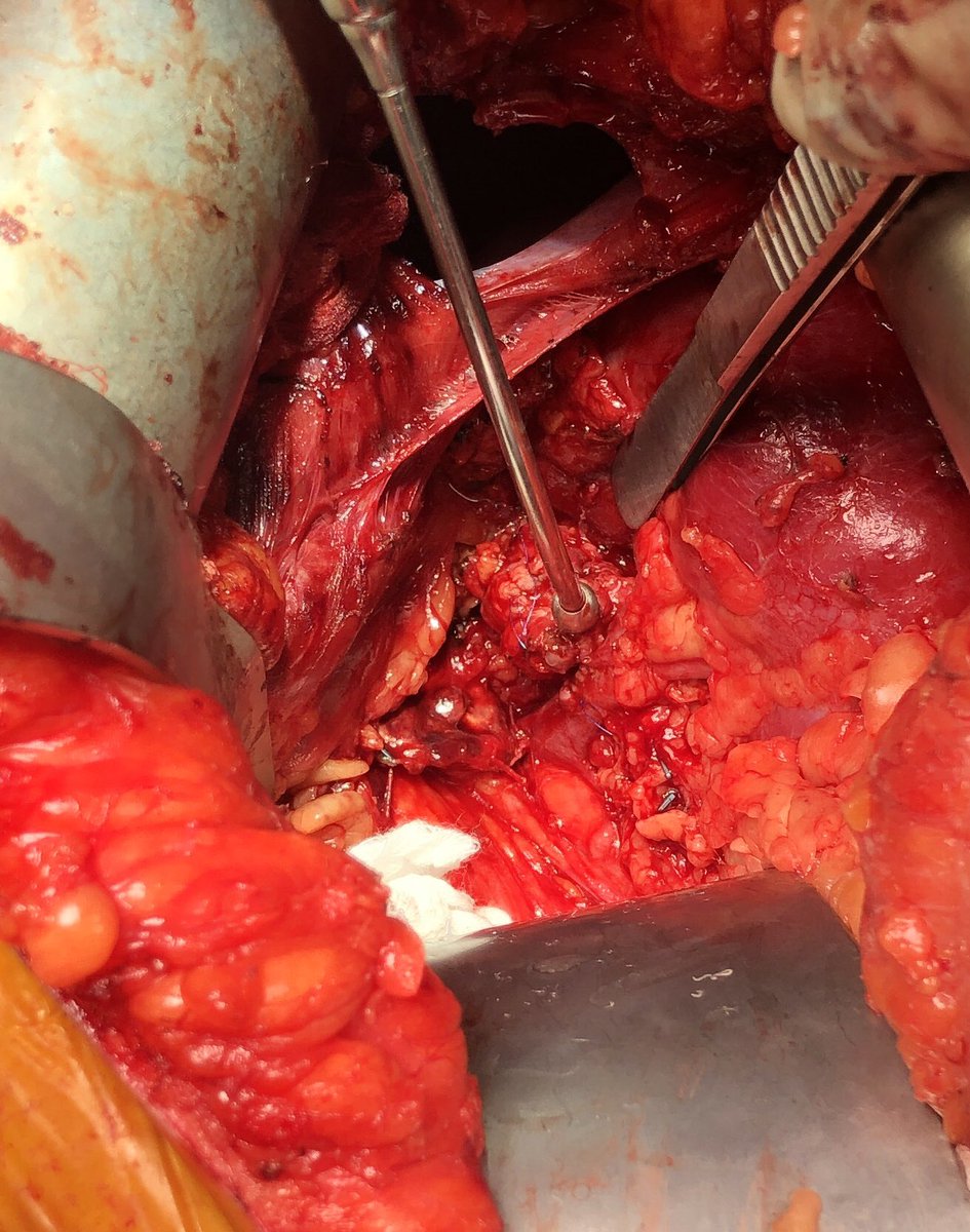 DrAliAzizzadeh's tweet photo. Open repair of #saccular left #renal #artery #aneurysm using patch angioplasty #VascularSurgery #VascularHealth @CedarsSinai https://t.co/ooXDvLTeNZ