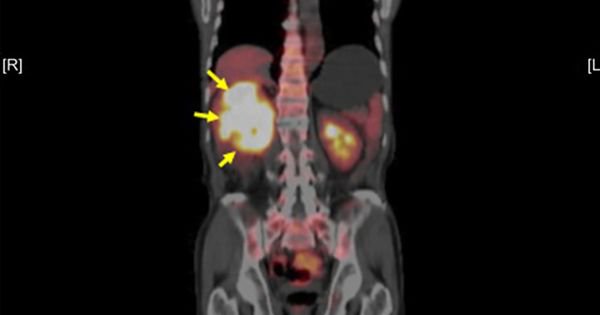 #Immunotherapies can extend survival beyond 3 years. Combination treatments including an immune checkpoint inhibitor &amp; targeted therapy #axitinib (Inlyta) led to better outcomes for advanced #kidneycancer patients than treatment with #sunitinib alone. - buff.ly/2WoCK0a