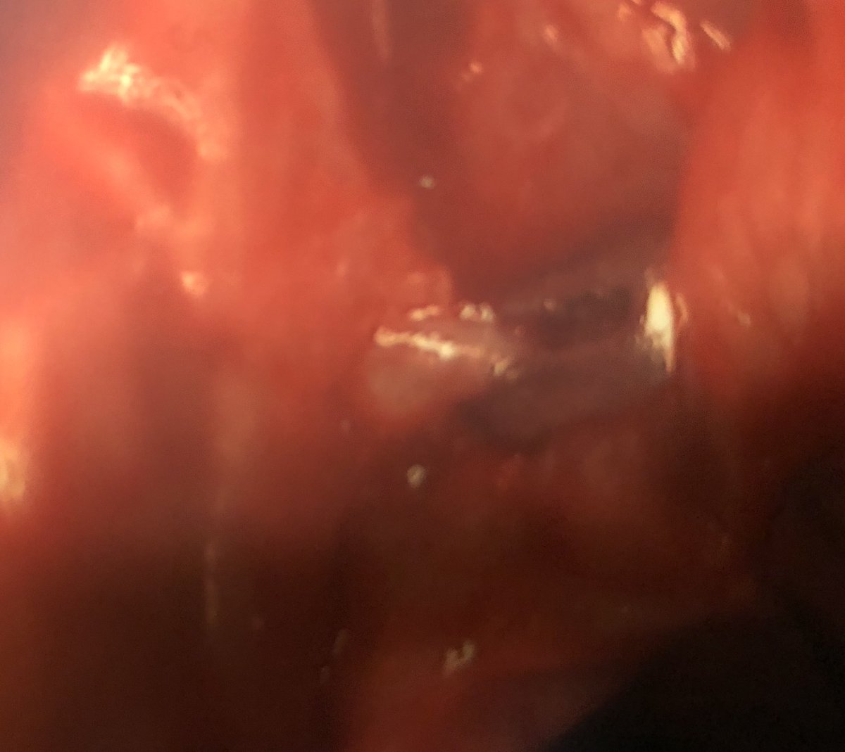 stamfordENT's tweet photo. Endoscopic Sphenopalatine artery ligation #otolaryngology #epistaxis #minimallyinvasive https://t.co/QhsPEAWwK9