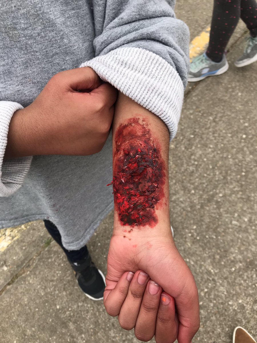 JessicaKontchou's tweet photo. “Ms. Kontchou, I hurt my—“ She got me good! @BBE_Bullfrogs #aprilfools #iwasntready #myheartfroze  #recessduty https://t.co/PXoSsJWMQZ