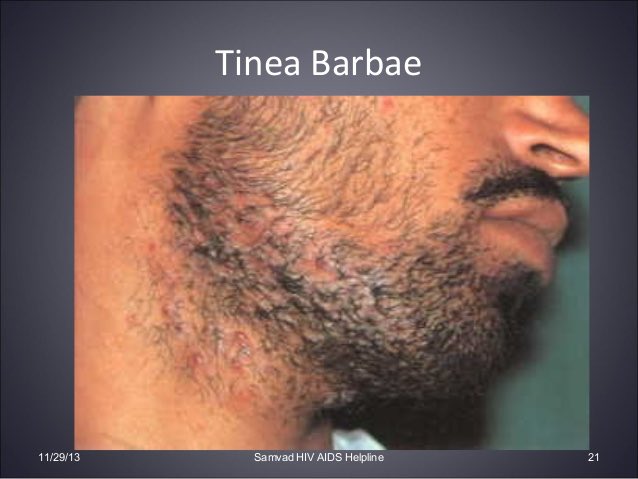 غيداء طلال بصفر🇸🇦 on X: ♦️Clinical findings:it's Causes dermatophytosis  1-Tinea capitis:infection in scalp👨🏼‍🦲and hair💇🏻‍♀️ 2-Tinea barbae:infection  in beard area🧔🏻 3-Tinea corporis:infection in the trunk🤽🏻‍♂️ 4-Tinea  cruris(jock itch