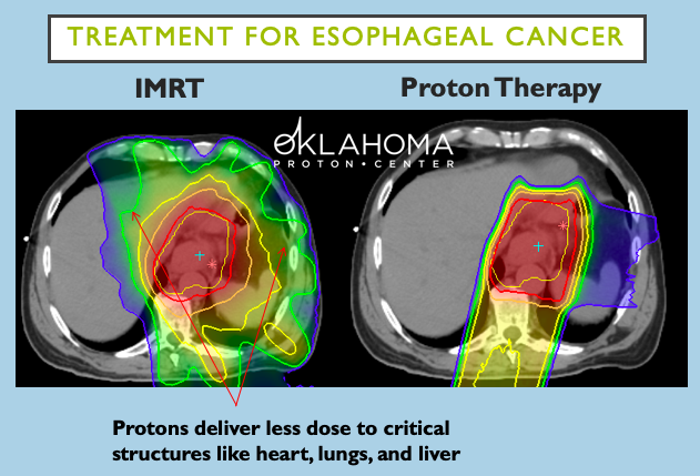 April is #esophagealcancer awareness month. For many patients, radiation is part of the treatment regimen. For these patients #protontherapy is often the BEST option to treat the cancer and eliminate unnecessary radiation to critical organs. <a href="/OKProtonCenter/">Oklahoma Proton Center</a>