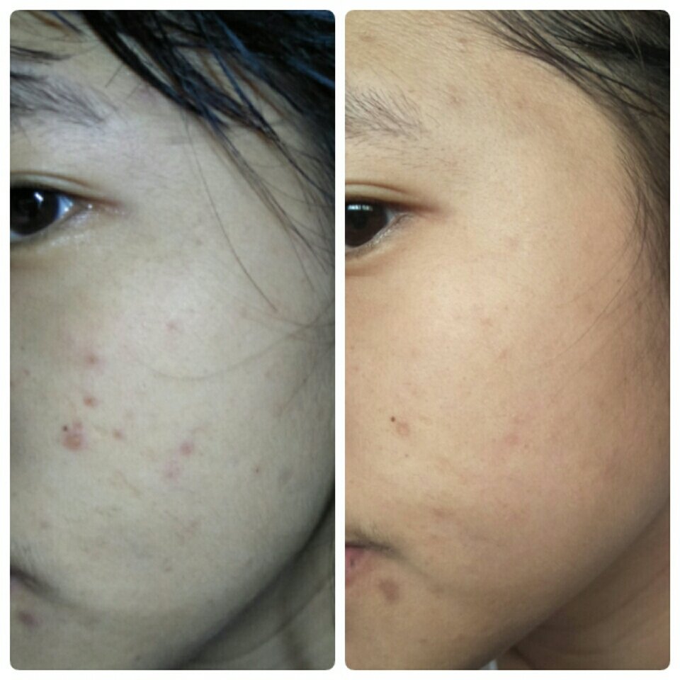 lilly_02018's tweet photo. Oxe'cure Anti Melasma Cream ครีมมช่วยลดฝ้ากระจุดด่างดำรอยสิว และยังช่วยลดการอักเสบจากสิว ทำให้รอยสิวค่อยๆจางหายไปด้วย ครีมตัวนี้ไม่ได้ทำให้ผิวแห้งด้วย เราใช้ตอนเช้า - ก่อนนอนทุกวัน  #ใช้ดีบอกต่อ #ไว้รีวิวห้ามขายของของโว้ยย https://t.co/ds9E9TnhDN