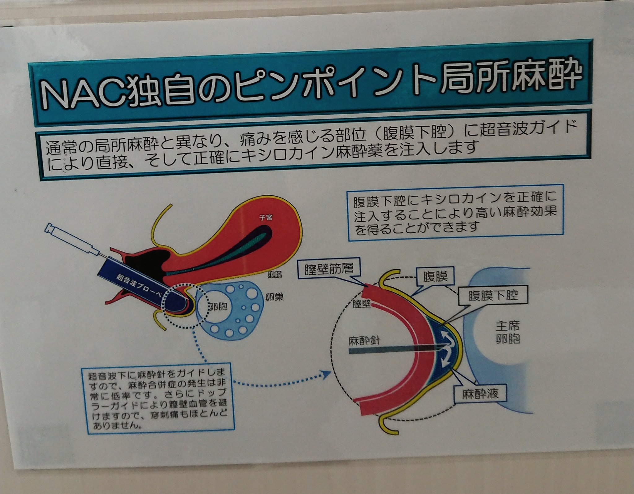 ちびベロ 採卵時の麻酔について 局所麻酔って打つのが痛そうと思ってたけど 未経験 これなら痛くないのかね 写真曲がっててｺﾞﾒﾝﾅｻｲ