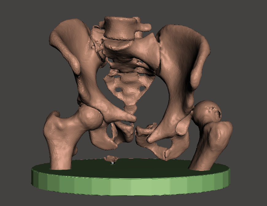 3d_maranon's tweet photo. 3D Model in EP of a complex fracture in the pelvis. This particular case will increase the repository of medical cases in the Hospital Gregorio Marañón. #HospitalMarañon3D FabLab team: @rupermac @calvoharo_ja @diegotrap @kn_ord @sandrasv97 https://t.co/HeRnk5yZHj