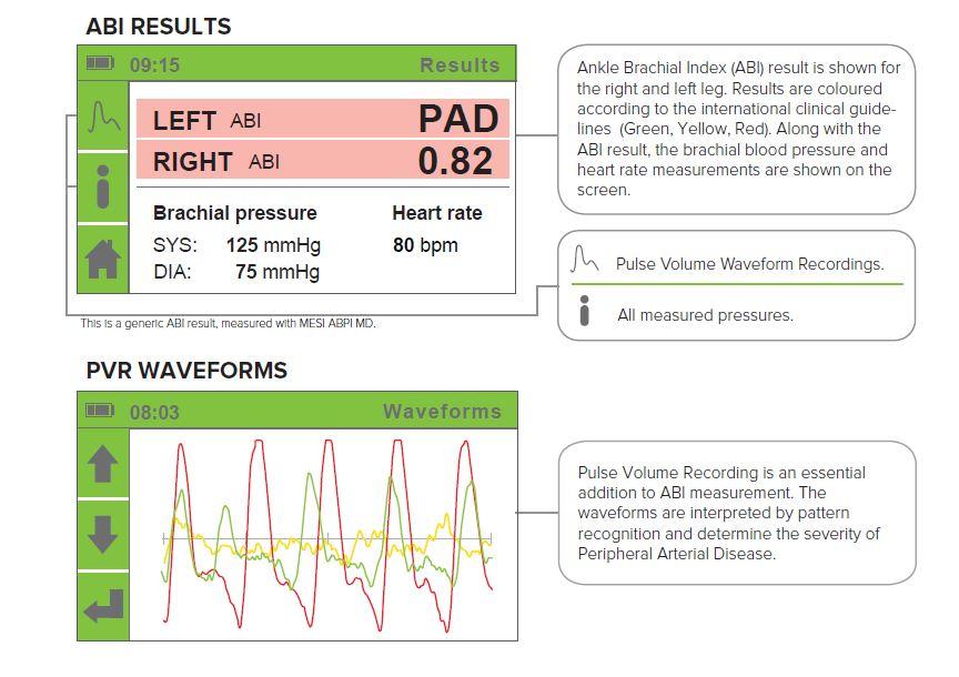 mediUKLtd's tweet photo. Our ABPI device also provides Pulse Volume Recording (PVR). Combining both ABPI & PVR represents *Best Practice* in evaluating the presence of Peripheral Arterial Disease (PAD). https://t.co/fPBB6GIVtk #ABI #ABPI #CorrectABI #3CUFF #NewTechnology https://t.co/xma7pzQTmk