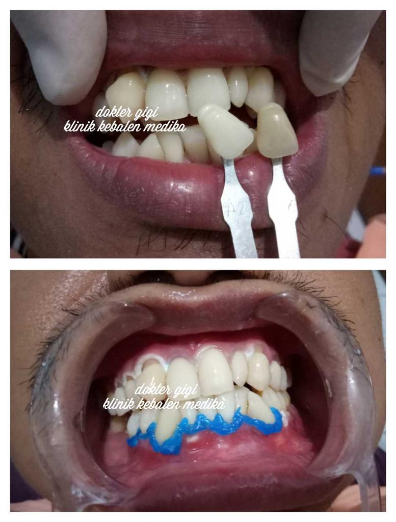 doc_irma's tweet photo. Promo bleaching 1jt
Klinik kebalen medika 
Wa : 083841508636 https://t.co/oQoKcLZIQi