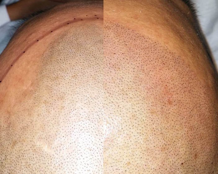 HEADLINERink's tweet photo. At #Headliner.Ink, we are always doing everything we can to ensure we are providing only the best #ScalpMicropigmentation out of #HuntingtonBeach and the surrounding areas. Give Us A Call at # (714) 800-9002 today! #Tricopigmentation #HairLossSolutions ... https://t.co/kfA3qOiTCP https://t.co/cQixu1USjZ
