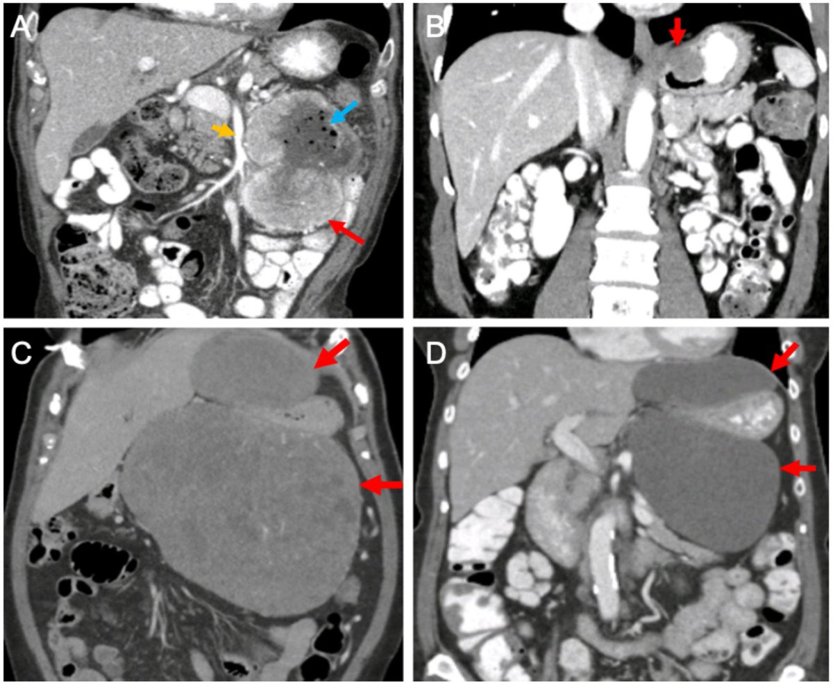 ACS Journal Cancer (@journalcancer) on Twitter photo The multidisciplinary management of primary gastrointestinal stromal tumors has evolved considerably over the last 20 years. This new review discusses surgical and medical considerations: ow.ly/4Xxq30oiin7 <a href="/dematteo_lab/">DeMatteoLab</a> The multidisciplinary management of primary gastrointestinal stromal tumors has evolved considerably over the last 20 years. This new review discusses surgical and medical considerations: ow.ly/4Xxq30oiin7 <a href="/dematteo_lab/">DeMatteoLab</a>