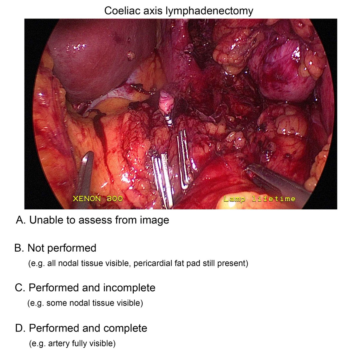 ROMIOStudy's tweet image. Are you an upper GI surgeon? Do you do oesophagectomies? What do you think about the quality of this coeliac axis lymphadenectomy?  #2of8 @cpbarham @NatalieBlencowe @TimTheSurgeon @apboddy @schoolofsurgery