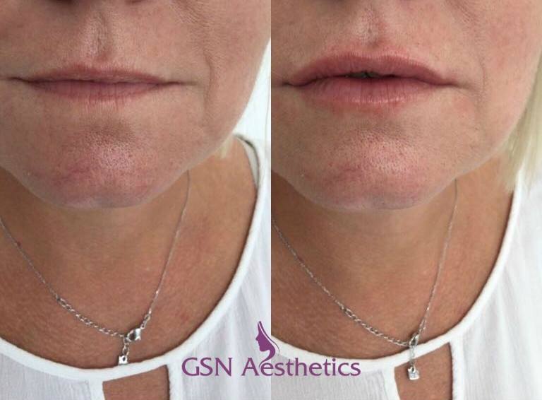 Lip fillers have a bad reputation of looking fake and overdone. But our results are proof that you can have natural looking results. 😊💜