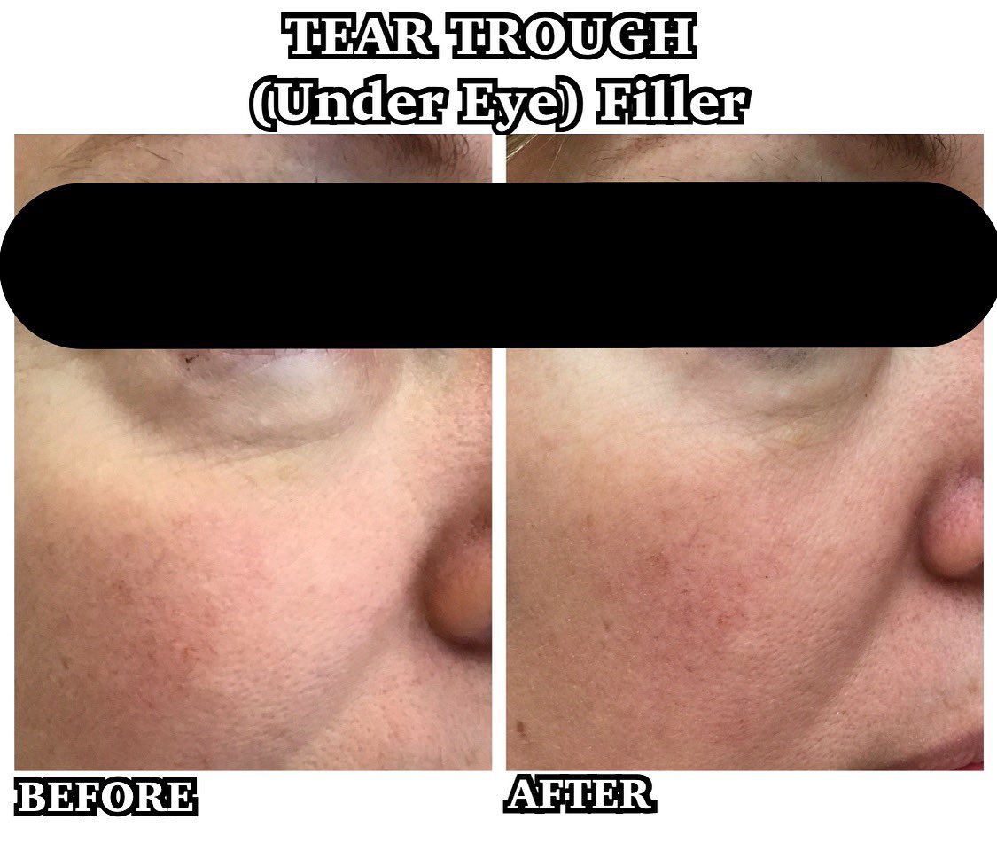 luminaskin's tweet image. Gorgeous Results with @juvederm! Call 650.401.6060 to schedule today! #Filler #Juvederm #Aesthetics
