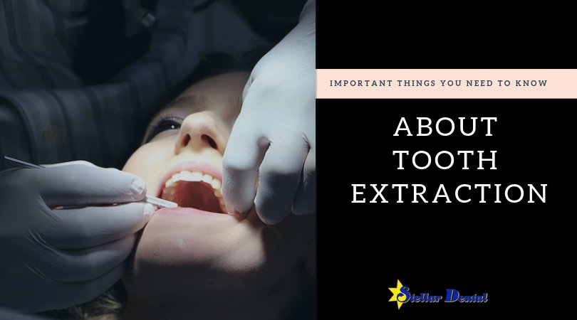 Here are some important things you should know before going in for a tooth extraction. stellardentalllc.com/blog/9-importa…  #toothextraction