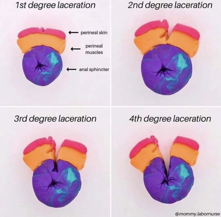 midwifery_nsu's tweet image. Great illustration of affected tissues in perineal trauma #perinealtrauma #visuallearner