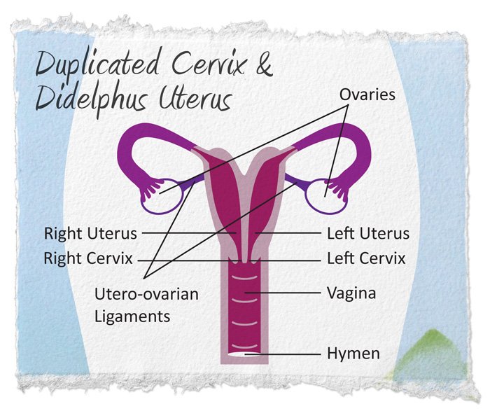 CodingcoachL's tweet image. ICD 10 Q51  A double uterus  develops when a baby girl is in her mother's womb. Every uterus starts out as 2  small tubes called Mullerian ducts. As they begin to develop, they usually fuse 2ogether to form 1 uterus.. a double uterus referred to as uterus didelphys
 #medicalcoder
