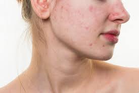 BBeautifulskin's tweet photo. Feel better and look better. Get rid of those acne scars with micro-needling. Call us to set up an appointment at 316-201-1205. https://t.co/xeX3TkLK46