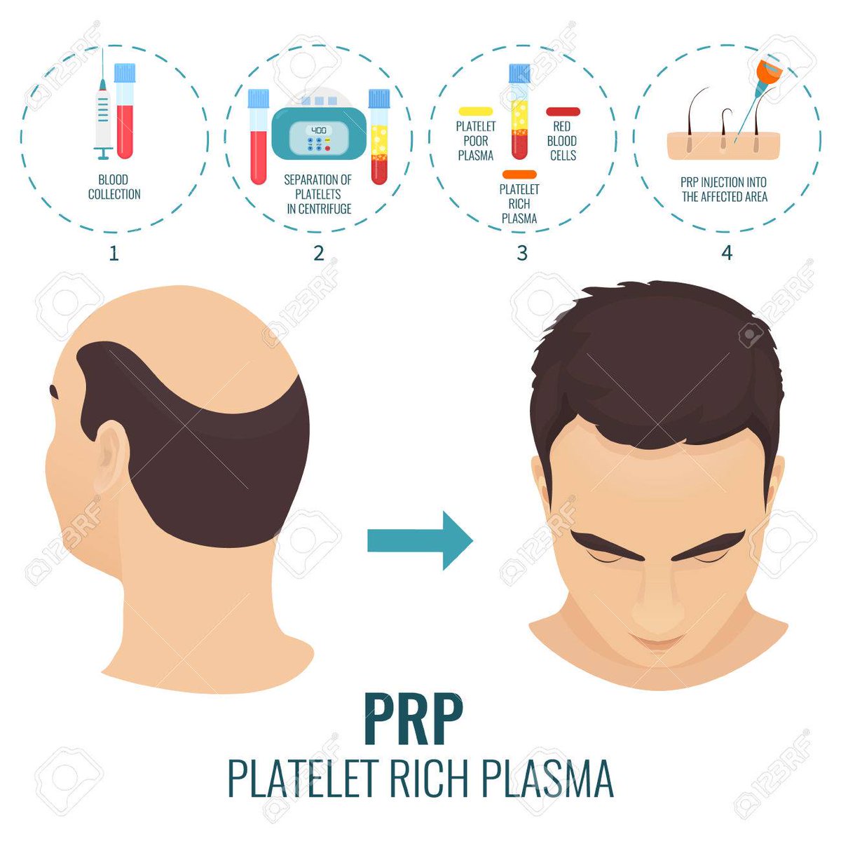 BBeautifulskin's tweet photo. You don't have to live with baldness. Platelet-Rich Plasma could help. Call us to schedule an appointment at 316-201-1205. https://t.co/8W5sErxOtL