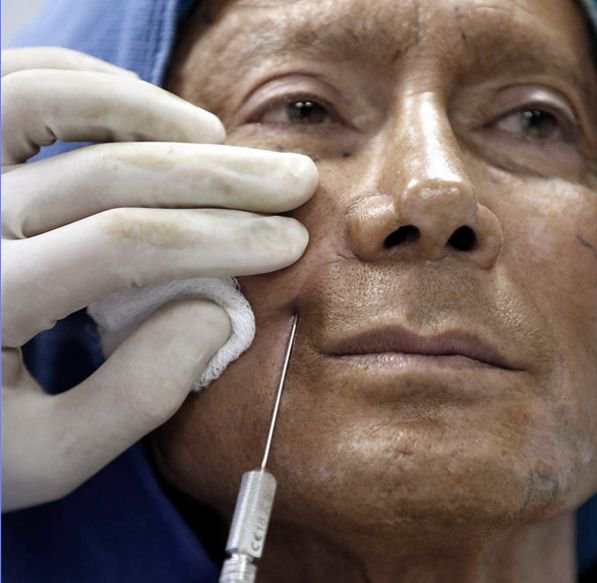 drnathannewman's tweet photo. One of the best parts about the #StemCellLift is that there is absolutely NO #CUTTING, NO #PULLING, and NO #STITCHING. As you can see here, the stem cells are all #injected into your face based on where Dr. Newman & you feel it is the best place based on your wants & needs https://t.co/BvtlaYwSZW