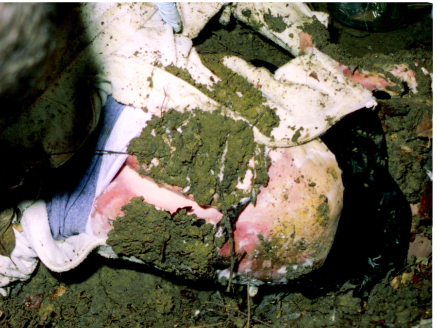 Adnans_Cell's tweet photo. @Way2GoRandi @JeffConcerto @EvidenceProf @HBO As you can see the right side of the abdomen looks nothing like the left side. The left side is almost completely pale, while the right side has the dark red staining of lividity. 

But the upper chest has lividity on both sides. https://t.co/Q8YjyympYi