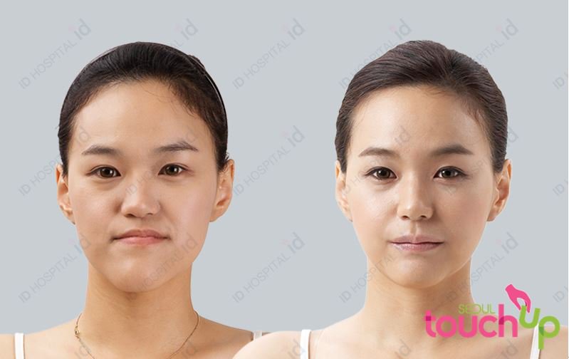 SeoulTouchUp's tweet photo. Check out this before and after photos from one of our patients.

https://t.co/2bVYQSEMSP 

#seoultouchup #seoultouchup_reviews #Vlinesurgery #facialcontouring  #plasticsurgeryinkorea #plasticsurgeryresults #plasticsurgeryreviews  #koreanplasticsurgery #genioplasty #jawbone https://t.co/qFRz0Rnzdd