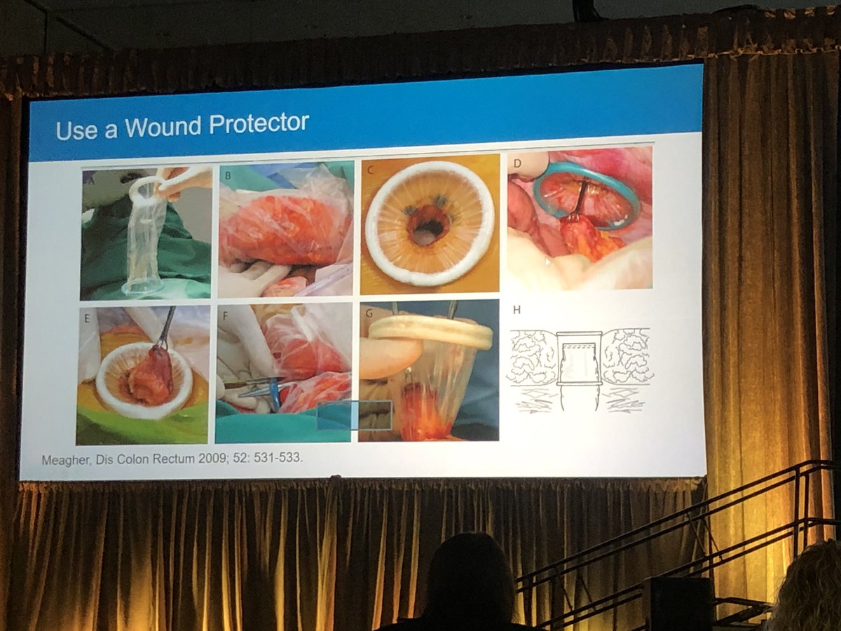 AppliedMed_CRS's tweet photo. Dr. Hiroko Kunitake describes how a #woundprotector can assist with stoma creation in challenging patients today at #SAGES2019 @SAGES_Updates https://t.co/t0HNhz1rci