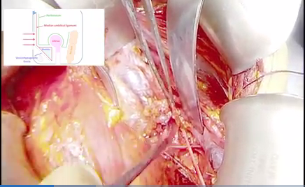 IJGConline's tweet photo. #Novel #surgical approach: Extraperitoneal radical #trachelectomy with pelvic #lymphadenectomy
#education #video #fertility #CervicalCancer #gynonc #endcancer #gyncsm @ESGO_society @IGCSociety https://t.co/qXCyr5N6RN https://t.co/tLaUwUDqoo
