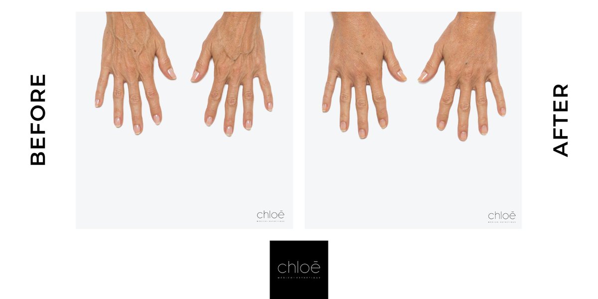 cliniquechloe's tweet photo. Treat Hands Wrinkles using Radiesse

#handrejuvenation #aginghands #radiesse #hands #hand #skin #botox #nosurgery #beautiful #beauty #naturalresults #bestdoctor #montreal #mtl #ccmtl #cliniquechloe https://t.co/1MOL6xeGLW