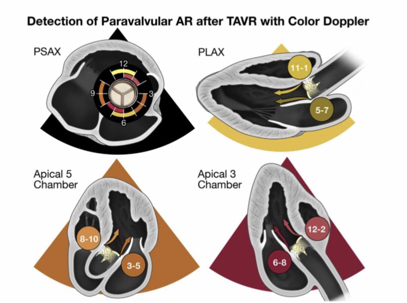 JGrapsa's tweet photo. Wonderful document: Guidelines for the evaluation of valvular regurgitation after percutaneous repair or replacement by @WilliamZoghbi @SLittleMD at #JASE @JournalASEcho https://t.co/DCizWr8ifF @mikepicardmd @BartsEcho @CardioMcgill @krychtiukmd @drlynnemillar @SilCastelletti https://t.co/9wcV0fpluQ