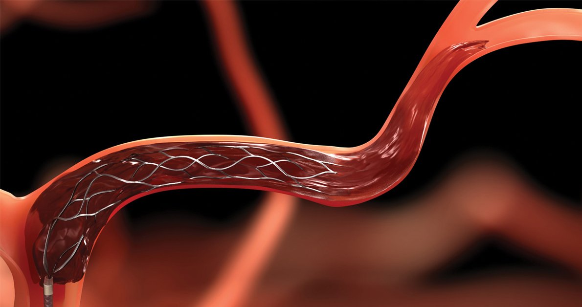 CRT_meeting's tweet photo. An aspiration-first approach to #thrombectomy not only matched #stentretrievers for #efficacy in #endovascular #stroketherapy, but may be cheaper, according to #COMPASStrial investigators.

Read more: https://t.co/QPM7x3n36U https://t.co/bO5RBJkTVO