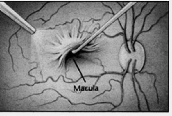 RetinaSERV's tweet photo. BLOG | ⏱ Esperar demasiado para indicar la cirugía de membrana epiretiniana empeora los resultados visuales.

No te pierdas el nuevo blog de la Dra. Beatriz Abadía ‼️
🔗 https://t.co/4Ij14DiLLI
#SERV19 #Cirugia #Epiretiniana #oftalmologia https://t.co/bdKV2TfLSC