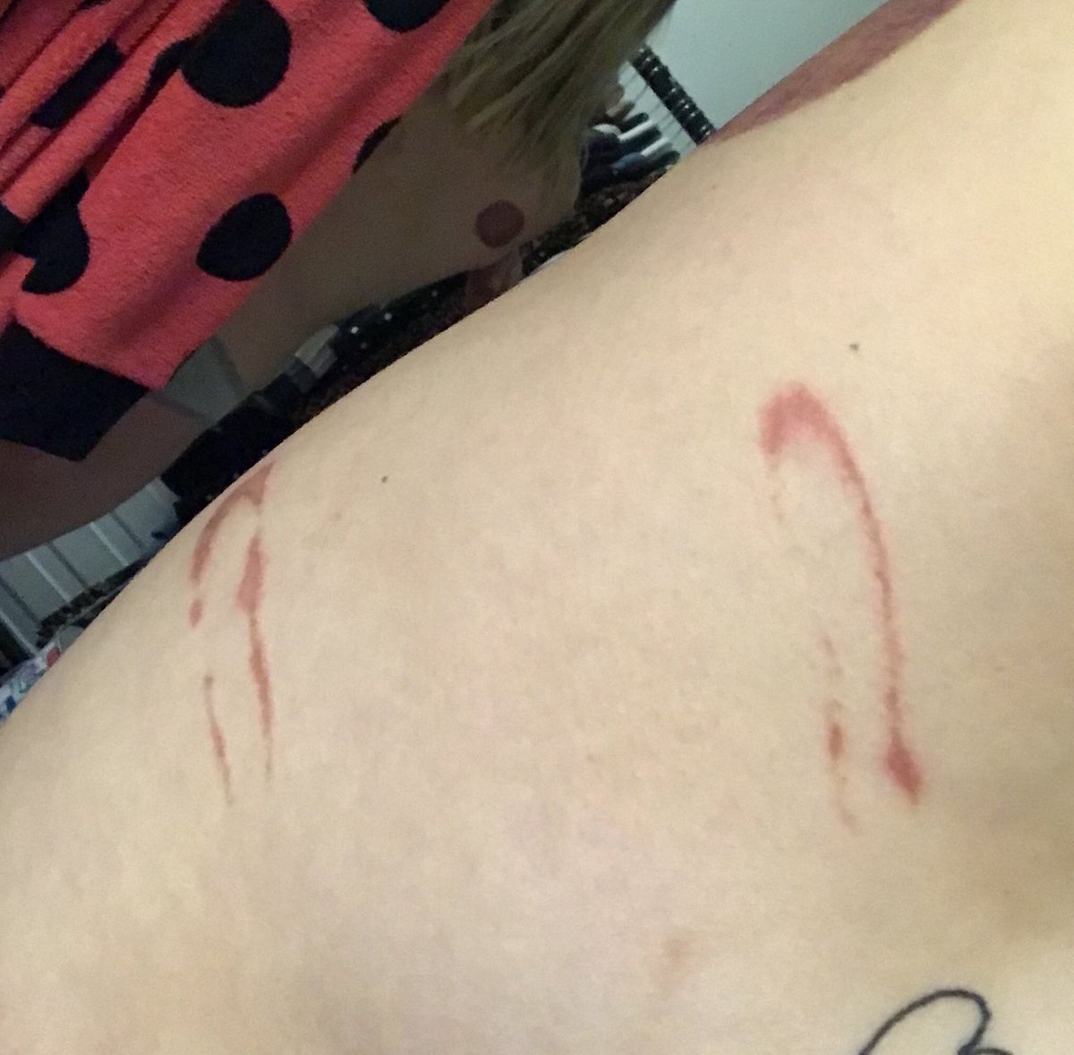 RebecaButtons's tweet photo. @Chinaturally1 
This Sunday had a great massage session. After the massage I had a Cupping session. Not sure how, the lady burnt my side with fire or hot water I’m not sure. This is what I was left with after 3 days. BE AWARE OF FLASHING IMAGES! https://t.co/j8dSupYNTf
