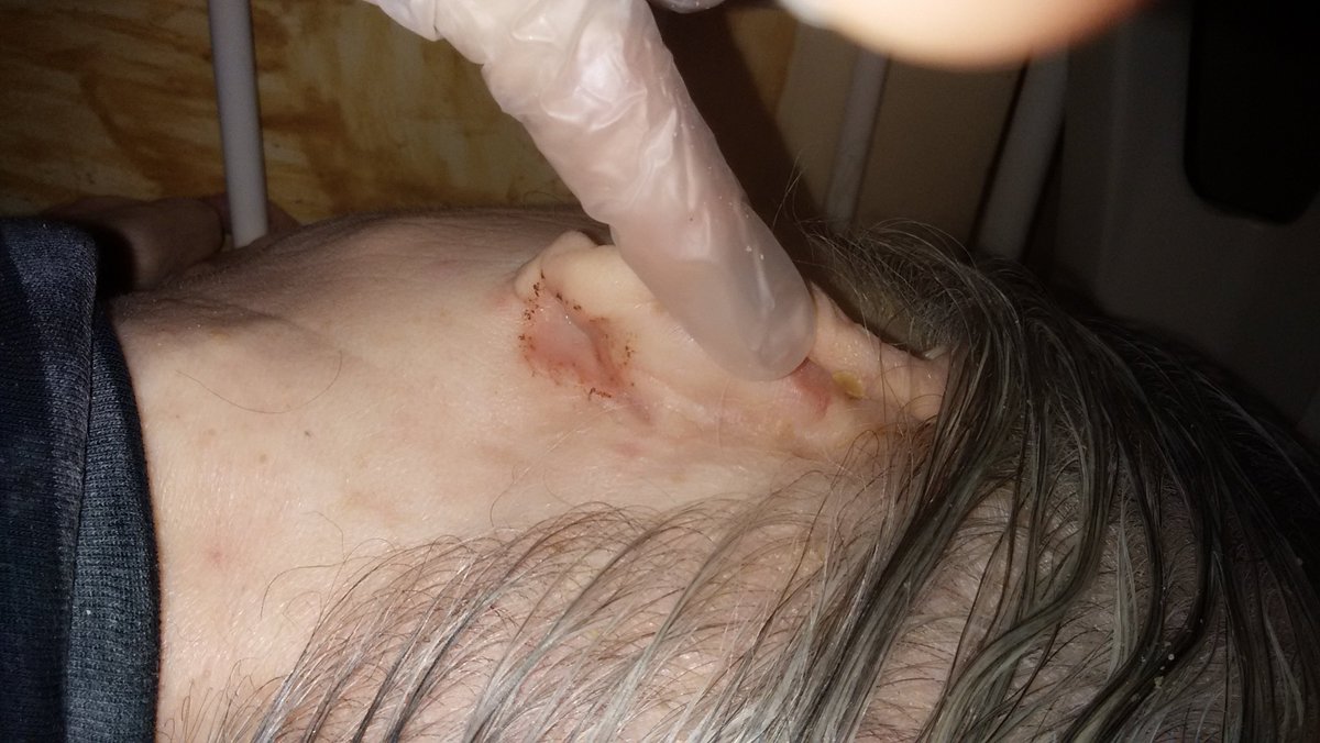 Mmfuku 母の耳の後ろへの攻撃の傷跡 一か月近くたつのに治らずに 強烈な臭いの膿が出る 私も耳の後ろが赤く炎症おこして薄皮が剥けたことがある 親子で同じ場所で同じ症状なんてあるのでしょうか Mmfuku 母の耳の後ろへの攻撃の傷跡 一か月近くたつのに治らずに 強烈な臭いの膿が出る 私も耳の後ろが赤く炎症おこして薄皮が剥けたことがある 親子で同じ場所で同じ症状なんてあるのでしょうか