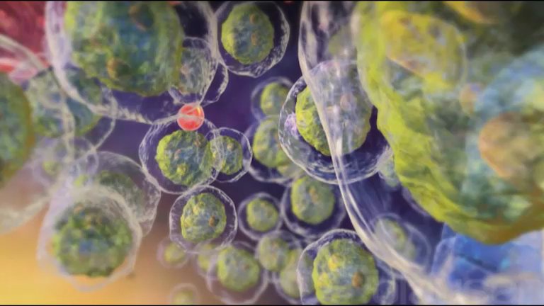 AKUT LÖSEMİLER 
#akutlenfoblastiklösemi #akutlösemi #akutmyeloidlösemi #all #aml #hematolojiistanbul #immünoterapi #kemoterapi #kökhücrenakli #lösemi #lösemitedavisi #memorialataşehirhematoloji #profdrhisari profdrhisari.com/akut-losemiler/