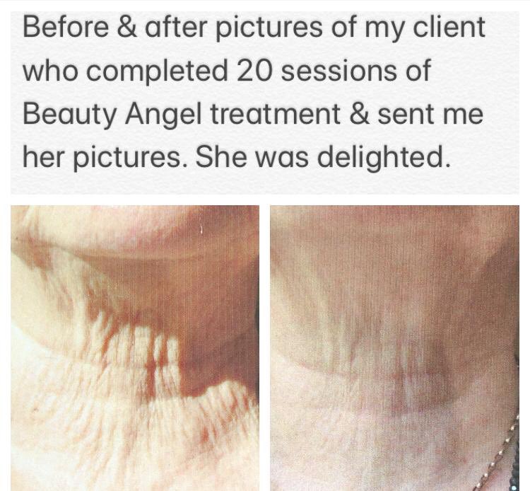 lipo_i's tweet photo. Have you tried Beauty Angel Light Therapy at Lisa’s?  
If you’re still yet to try this amazing 15 minute treatment please don’t hesitate to contact me to book a FREE treatment, alternatively see prices below:
£15 pay as you go
£125 for 10 treatments 
£200 for 20 treatments https://t.co/lQ5y9AiT7a