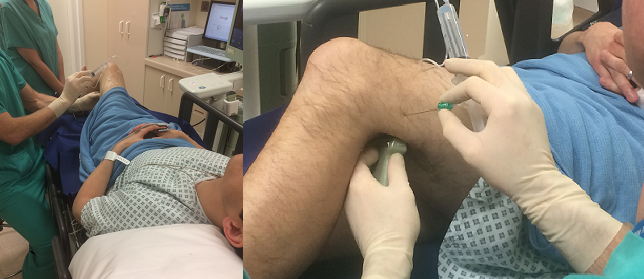 wfsaorg's tweet image. NEW ATOTW PUBLISHED: #401 Ultrasound-Guided Popliteal Block. A review of the anatomy of the sciatic nerve and its branches, and the indications, contraindications and technique for ultrasound guided popliteal block.
Read it here: bit.ly/2fzHv47
#AnaesthesiaEducation