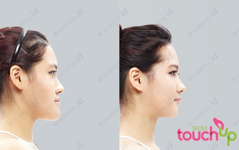 SeoulTouchUp's tweet photo. Check out this before and after photos from one of our patients.

https://t.co/2bVYQSEMSP  

#seoultouchup #seoultouchup_reviews #Vlinesurgery #facialcontouring  #plasticsurgeryinkorea #plasticsurgeryresults #plasticsurgeryreviews  #koreanplasticsurgery #genioplasty #jawbone https://t.co/Gll6MdDML1