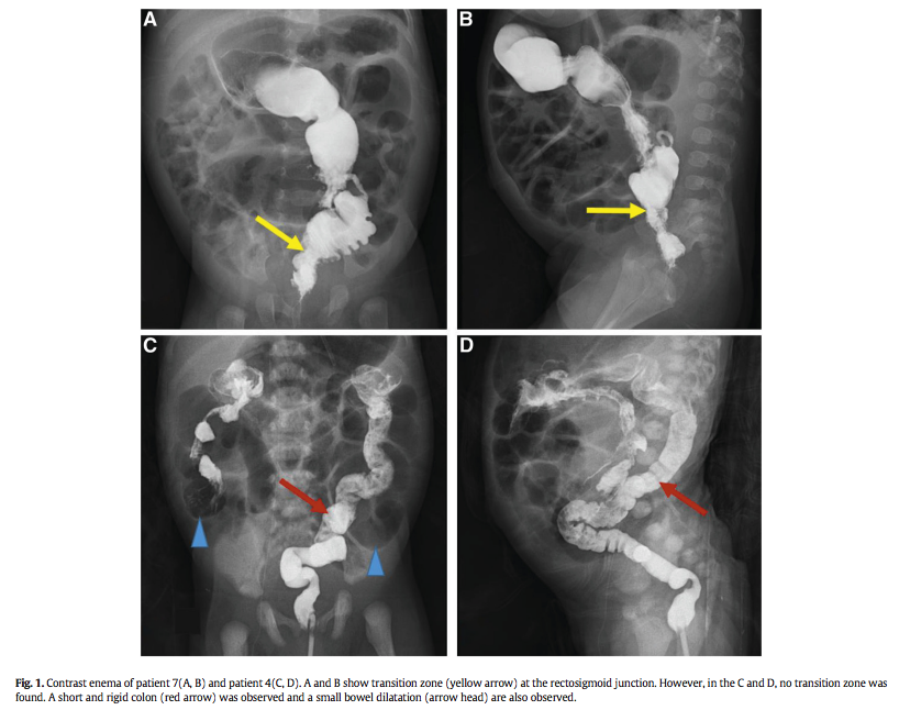 jpedsurg's tweet photo. Clinical features of children with Haddad syndrome: A single-center experience https://t.co/7TJVo0m2zQ #jpedsurg #PediatricSurgery #Prognosisstudy #Haddadsyndrome #Hirschsprungsdisease #PHOX2B @SNUnow @UniversityKorea https://t.co/zsKq4CZQr5