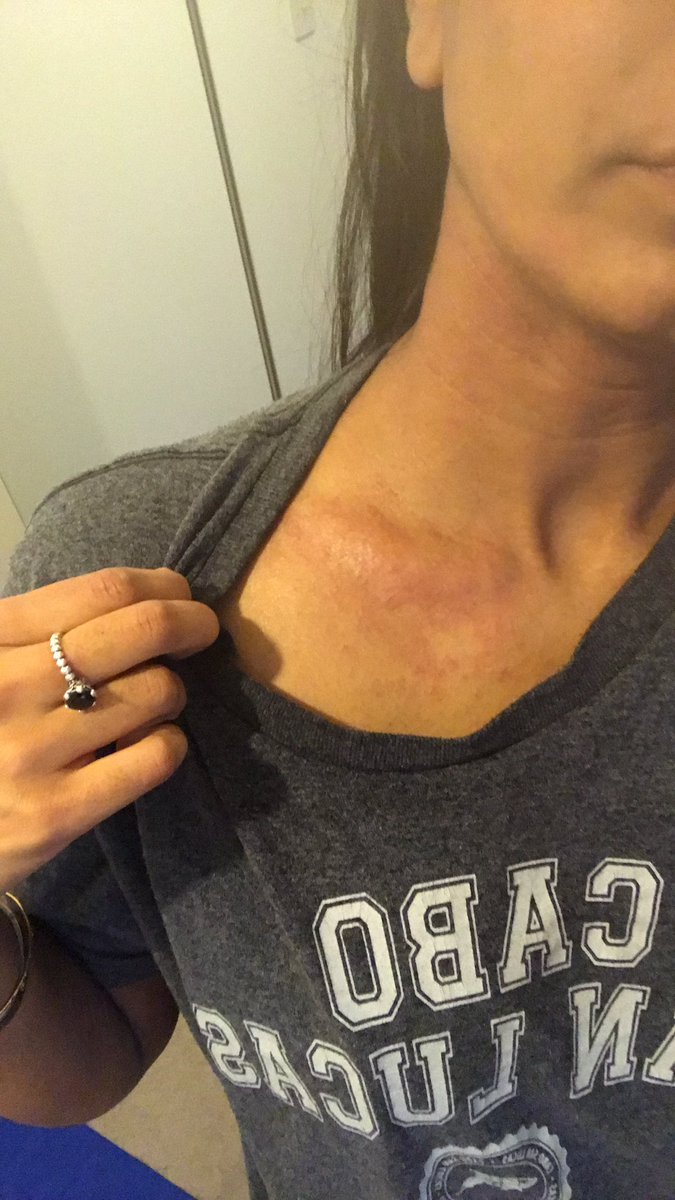 Pollen season is here and it brings up my eczema. Fun fun fun when your allergies are airborne...what do you use to combat pollen allergy? #eczema #hayfever