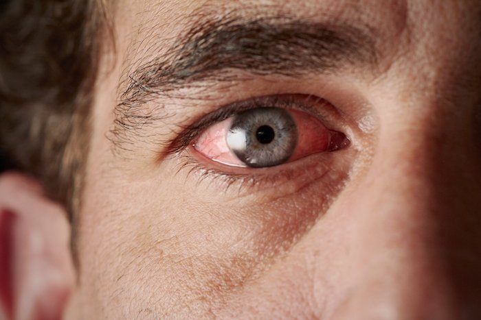 RichlinAssoc's tweet photo. If your eyes are red, irritated, or incredibly painful, contact the optometrists at Dr. Richlin, O.D. &amp; Associates right away!

#stevensjohnsonsyndrome #optometry #losangeles #eyecare #optometry #eyedoctor https://t.co/vW2lnduwFK