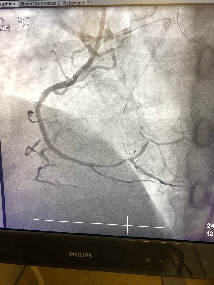 KeithNguyenSAIF's tweet photo. Reverse Cart CTO intervention to the RCA. @SAIFSanAntonio @JamilMalikSTCC @BrianHainesSAIF @RudyD_SAIF @mibarraSAIF @Jamie_AM_Abbott @JAG24851 https://t.co/eoc69vmAP7