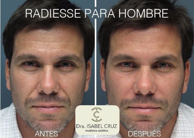 Мужчина после ковида. Контурная пластика лица мужская. Скулы операция до и после мужчины. Филлеры мужчинам до и после.