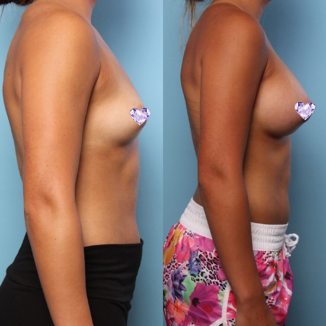 FinessePS's tweet photo. There are over one thousand different breast implants available for patients in a variety of sizes, styles and shapes. During your consultation we will help you choose the best implants for you based on your goals and your body.  #breastsurgery #beforeandafter #plasticsurgery https://t.co/nvXC4jk7fH