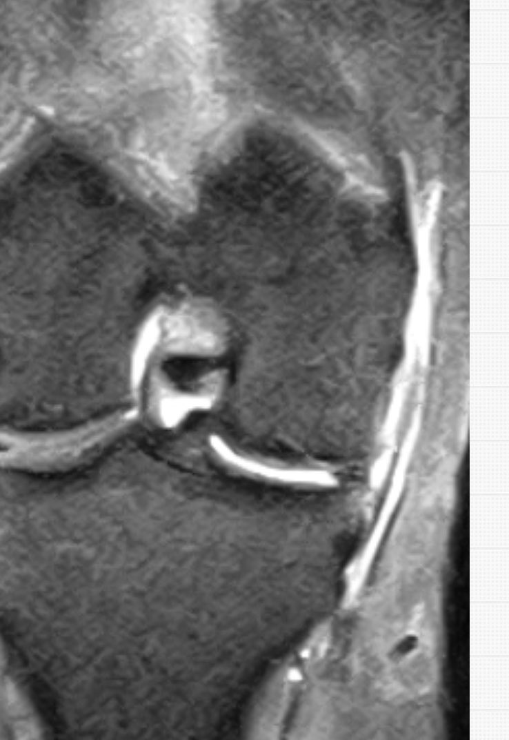 trauma_modern's tweet photo. Rotura en asa de de cubo #menisco interno. ✅menisco en escotadura que desplaza el LCA en la #rodilla ✅supone un bloqueo para la extensión : signo del puente ✅RM:Signo del doble #ligamento cruzado posterior #traumamodern https://t.co/SQMxXdl61P