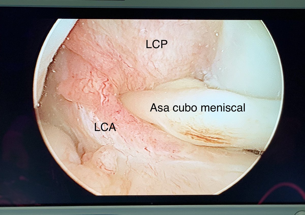 trauma_modern's tweet photo. Rotura en asa de de cubo #menisco interno. ✅menisco en escotadura que desplaza el LCA en la #rodilla ✅supone un bloqueo para la extensión : signo del puente ✅RM:Signo del doble #ligamento cruzado posterior #traumamodern https://t.co/SQMxXdl61P