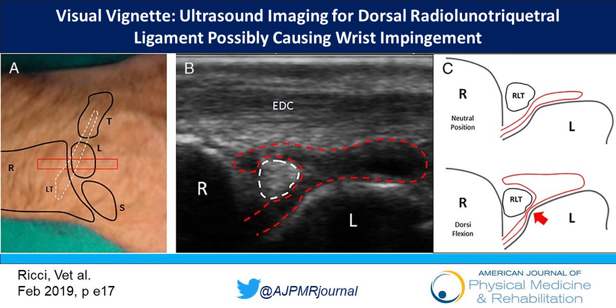 AJPMRjournal's tweet photo. #VisualVignette:  Ultrasound Imaging for Dorsal Radiolunotriquetral Ligament Possibly Causing Wrist Impingement - New research from Dr. @riccivincenzo17    https://t.co/xANjdigm4N #Physiatry https://t.co/7IvwlsG6qw