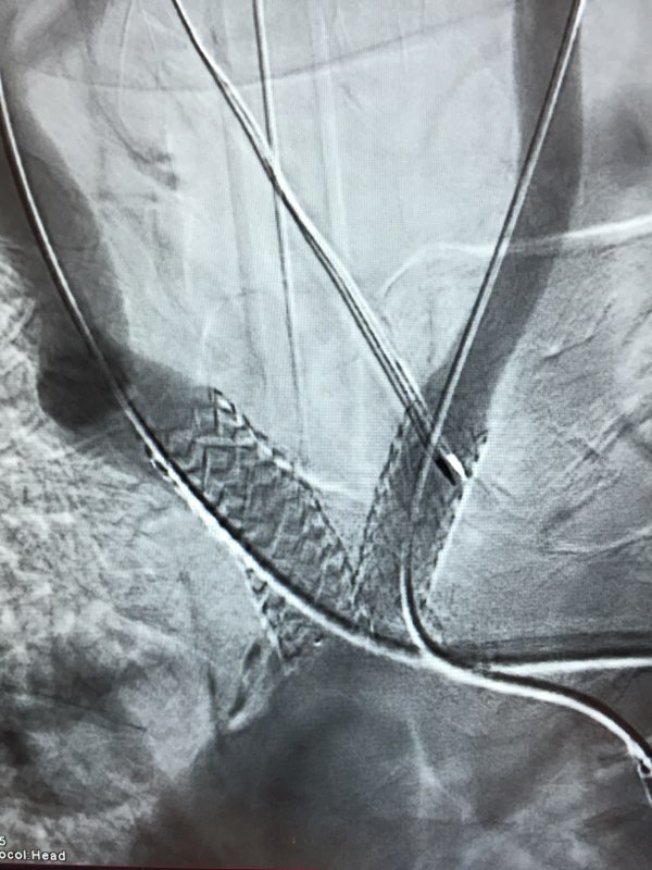 Again #iRad #withoutascalpel #kissingstents