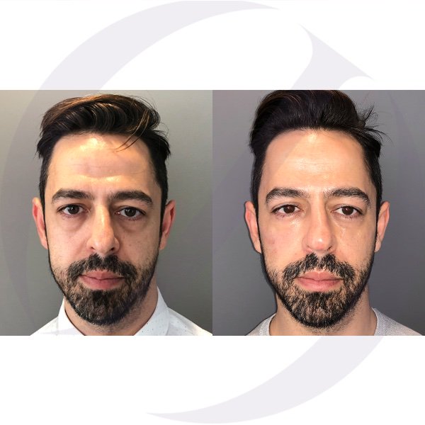 Dr_OscarJunco's tweet photo. Mantén la mirada joven y radiante, en tan solo 15 minutos, sin anestesia local y pudiendo continuar con las ocupaciones diarias #ojeras #drjunco #acidohialuronico https://t.co/MhCD4AvtXo