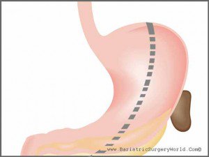 BariatricWorld's tweet photo. Mexicali is the place to get #gastricsleeve surgery 💪in Mexico if you wish to experience a #familiar environment. With its American feel and look, the city has attracted many US residents. Get more information on https://t.co/kcO3Zydfb6