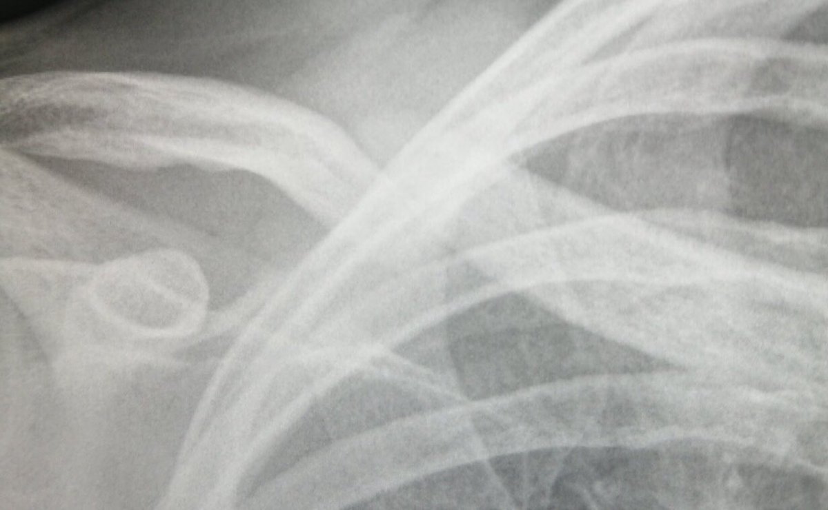 mnc_electrical's tweet photo. Oh yeah, have been signed off from the fracture clinic. Bone has taken and has started to fuse together the whole way around now. Let’s get the muscle around it back now. #collarbone #onthemend #yesyesyes #fridayfeeling #physiotime https://t.co/qpV8vzW2lO