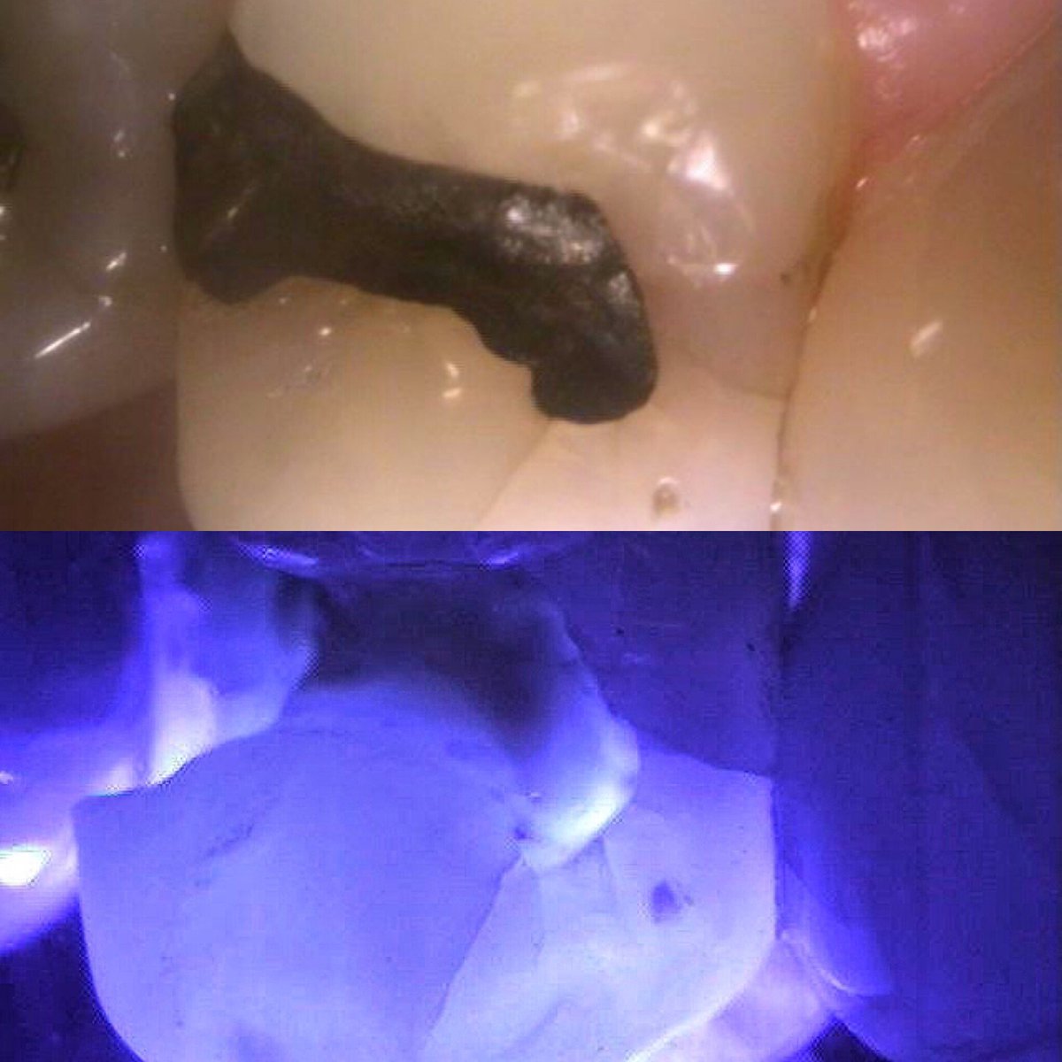 smilesofboca's tweet photo. Cracks on a #tooth next to an #amalgam filling

#dentistry #smiles #crackedtooth #bocaraton #macro #smilesofboca https://t.co/vbRXk0YWvu
